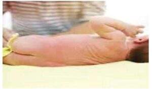 4063 babies stool may cause diarrhoea hepatitis paediatrician warns