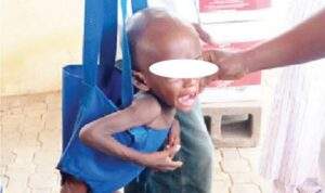 9067 malnutrition may delay childrens recovery from infections dietician