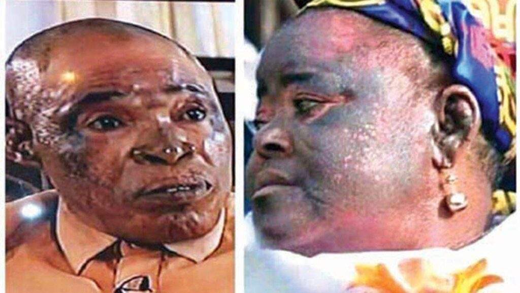 17465 nafdac declares state of emergency on skin bleaching