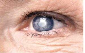 19008 no glaucoma