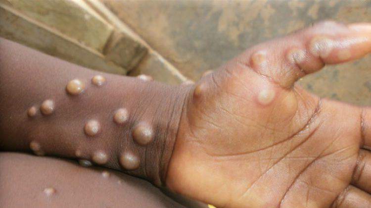 20856 monkeypox