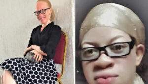 23296 ngo condemns skits stigmatising albinos