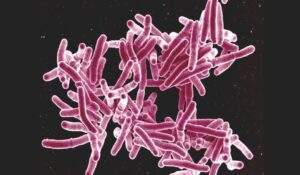 34325 experts differ on fgs commitment to ending tuberculosis