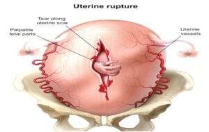 35100 rising uterine rupture endangers pregnant women