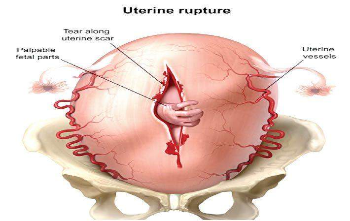 35100 rising uterine rupture endangers pregnant women 35100 rising uterine rupture endangers pregnant women