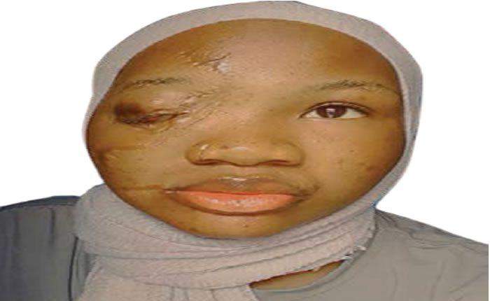 42882 classmates mocked called me one eyed girl visually impaired student
