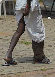 44080 ondo residents receive free elephantiasis surgery