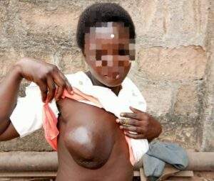52751 mother of two to undergo breast cancer surgery husband seeks help