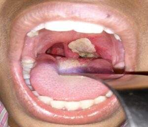 56464 nigeria records 557 diphtheria cases 73 deaths