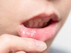 60454 expert advocates early diagnosis of oral cancer