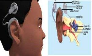 60793 cochlear implants a mechano electric device giving hope to the deaf