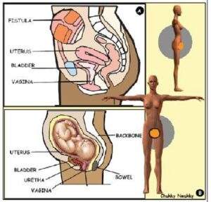 65508 nigeria records 12000 new cases of obstetrics fistula annually says consultant surgeon