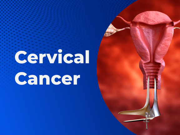 71451 bleeding after intercourse may be sign of cervical cancer expert