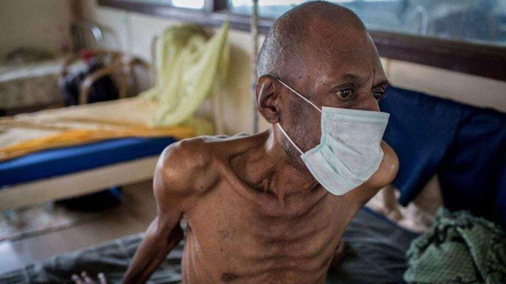 76500 new tb vaccine in 100 years advances as wellcome gates foundation fund trial 76500 new tb vaccine in 100 years advances as wellcome gates foundation fund trial