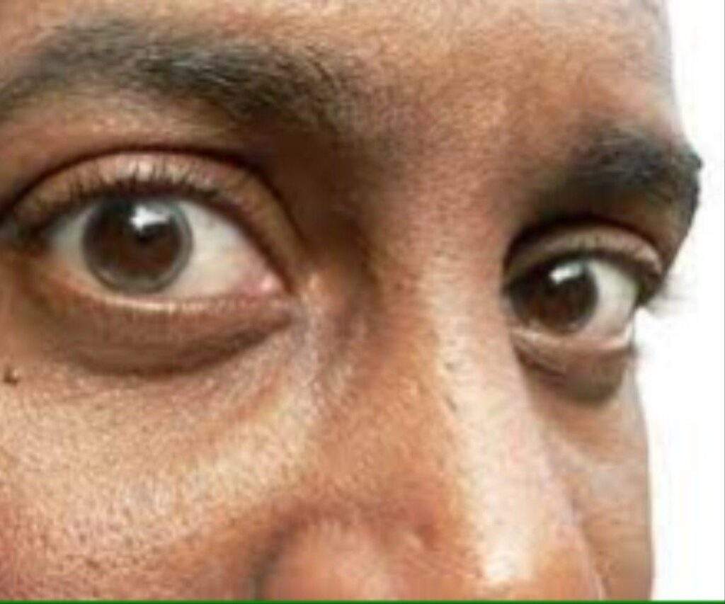 82333 igbo yoruba elderly men at higher risks of glaucoma induced blindness expert warns