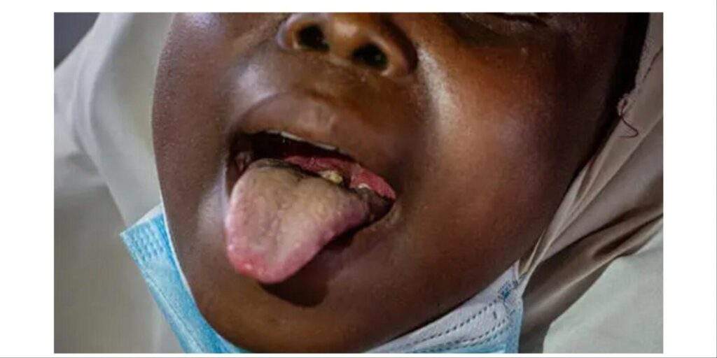 108073 diphtheria outbreak claims 10 lives in jigawa state