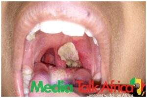 115988 diphtheria yobe records 117 deaths 1796 suspected cases