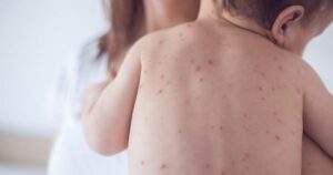 1708445961 WHO raises alarm over rapid spread of measles cases