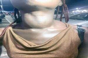 goitre 2