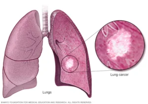 lung cancer tumor 8col