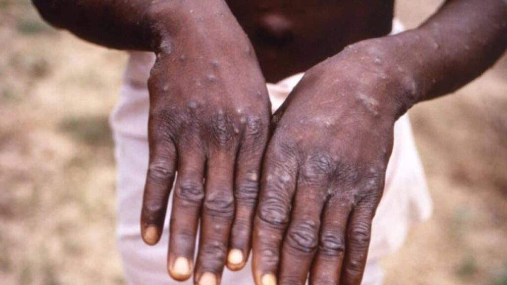 Fending Off Zoonotic Infections: Virologist Calls for Holistic Approach to