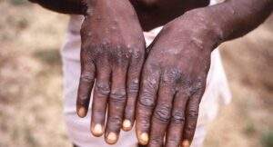Mpox Outbreak Declared Public Health Emergency of International Concern By