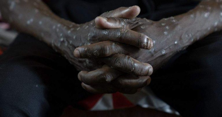 Congolese Authorities Receive 50,000 Smallpox Vaccines