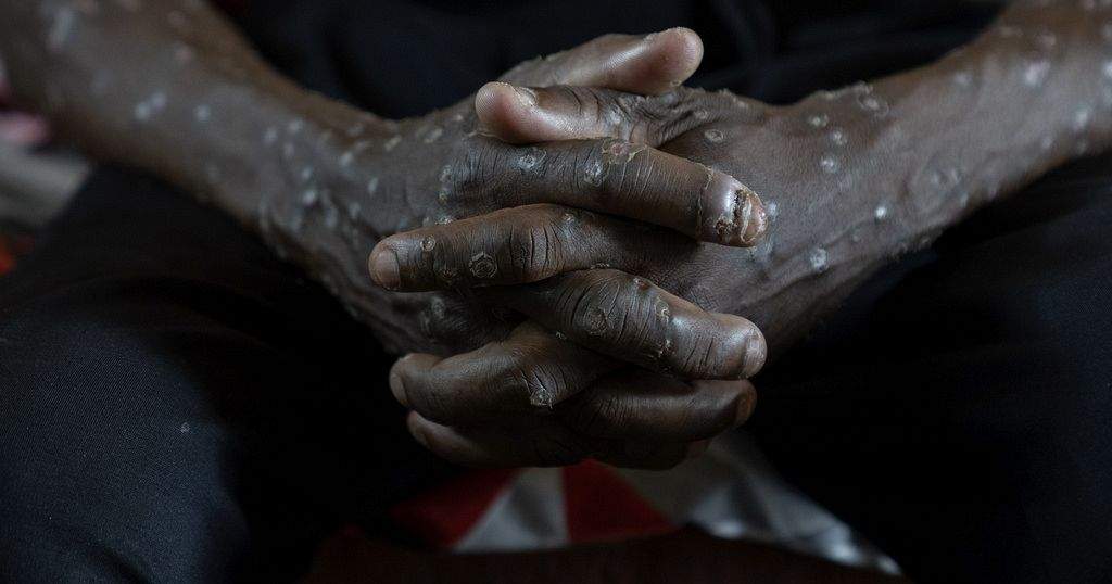 Congolese Authorities Receive 50,000 Smallpox Vaccines