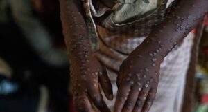 Mpox Case Recorded In Marrakesh Moroccos First 300x162