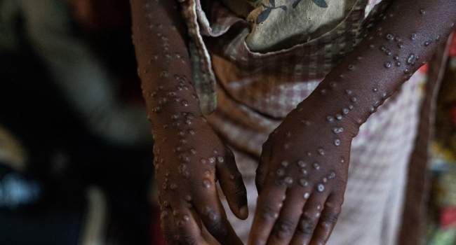 Mpox Case Recorded in Marrakesh, Morocco's First