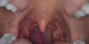 Oral Sex Linked to Rising Throat Cancer Cases