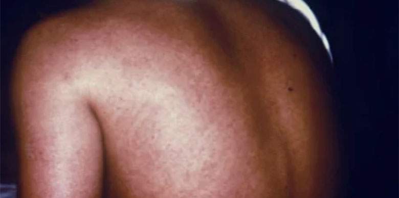 Rwanda Confirms 27 Marburg Virus Cases 9 Deaths Amid Outbreak