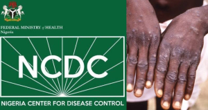 NCDC raises alarm over multiple disease outbreaks, calls for urgent measures — Daily Nigerian