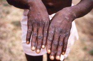 Ondo State Reports 12 Mpox Cases Vaccination In 8 LGAs 300x197