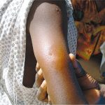8 persons killed as Adamawa govt  confirms outbreak of suspected Buruli ulcer — Daily Nigerian