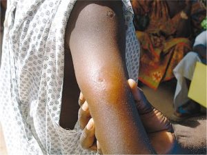 8 persons killed as Adamawa govt  confirms outbreak of suspected Buruli ulcer — Daily Nigerian