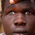 23 million Nigerians suffer from eye problems - Expert