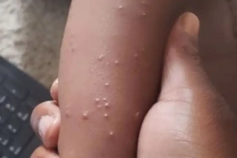 Scabies infects 150 in Adamawa
