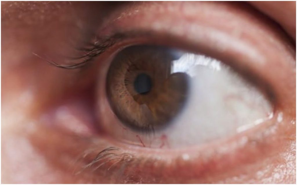 Experts raise concerns as glaucoma cases surge in Plateau