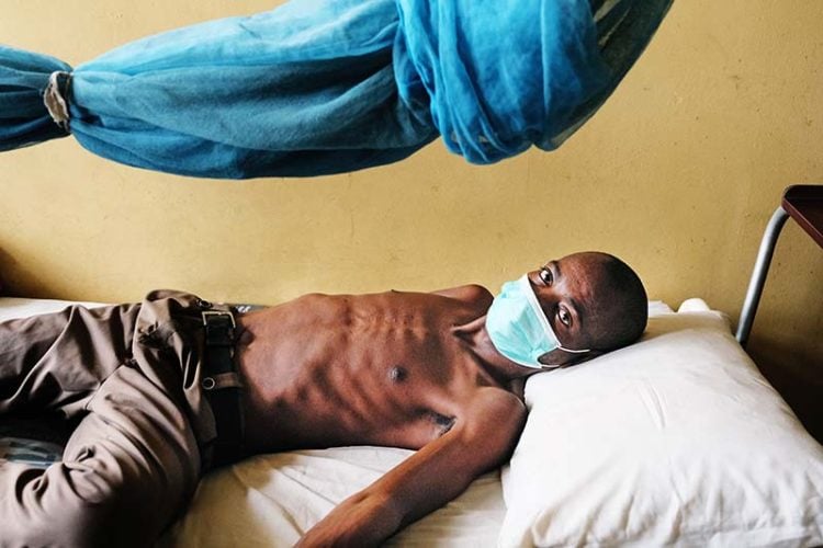 8,629 Tuberculosis cases treated out of 14,908 cases identified in Niger