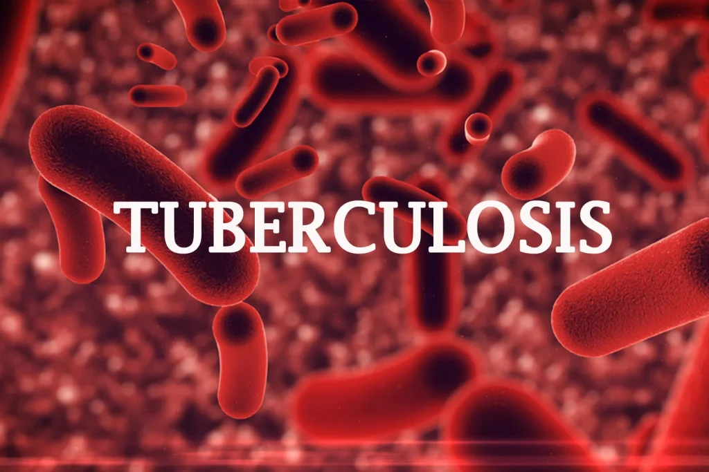 Plateau recorded over 5,000 tuberculosis cases in 2025 — Commissioner