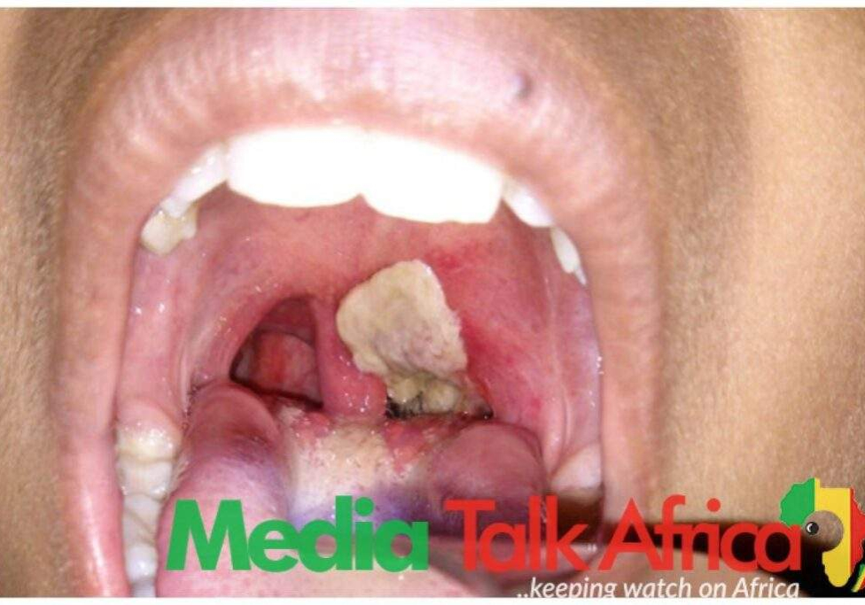 115988 diphtheria yobe records 117 deaths 1796 suspected cases 115988 diphtheria yobe records 117 deaths 1796 suspected cases