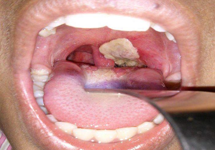 12213 Diphtheria