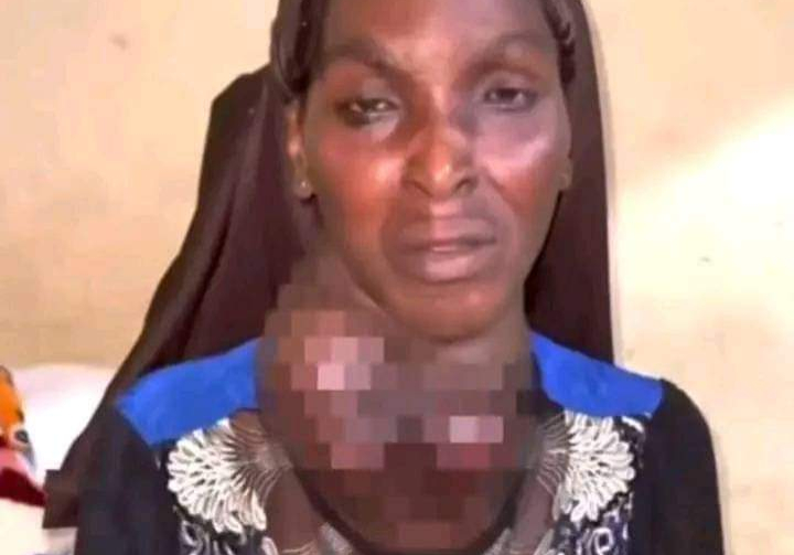 134280 osun state government extends support to goitre patient amid controversy