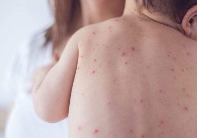 1708445961 WHO raises alarm over rapid spread of measles cases