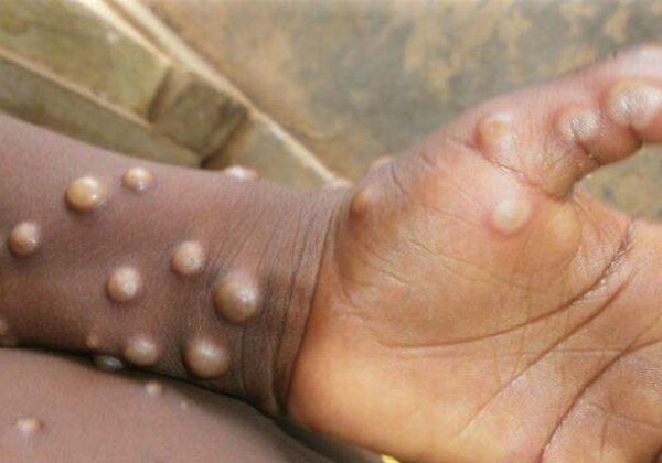 20856 monkeypox 20856 monkeypox