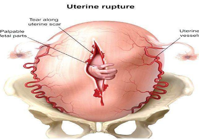 35100 rising uterine rupture endangers pregnant women 35100 rising uterine rupture endangers pregnant women
