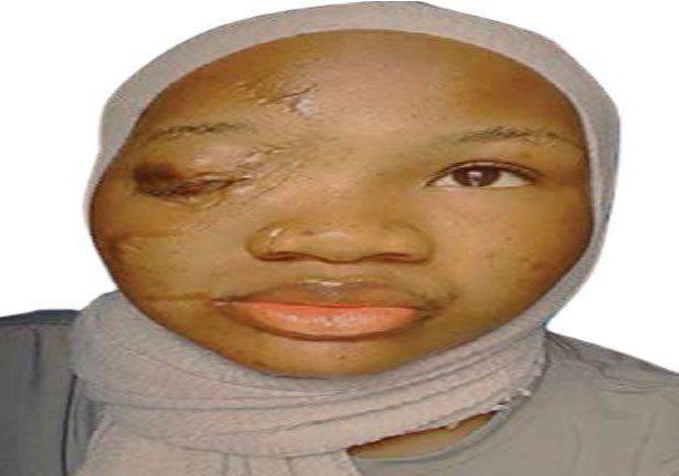 42882 classmates mocked called me one eyed girl visually impaired student