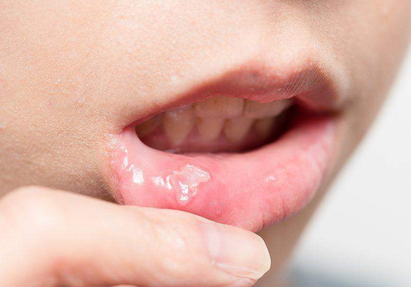 60454 expert advocates early diagnosis of oral cancer 60454 expert advocates early diagnosis of oral cancer