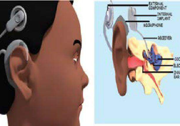 60793 cochlear implants a mechano electric device giving hope to the deaf 60793 cochlear implants a mechano electric device giving hope to the deaf